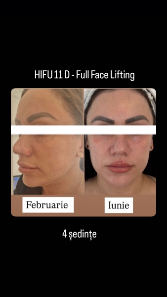 Tratament cicatrici acneice la Skin Medica București